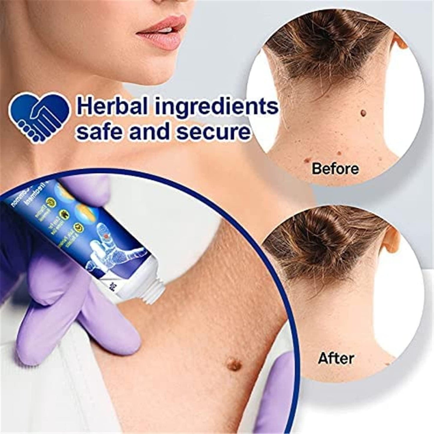 Instant Wart remover